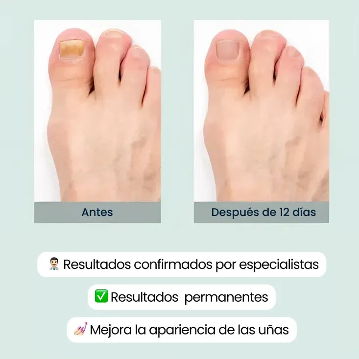 ToenailPlus® | Potente eliminador de hongos de uñas